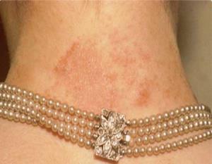 Penyebab Terjadinya Alergi Saat Mengenakan Perhiasan